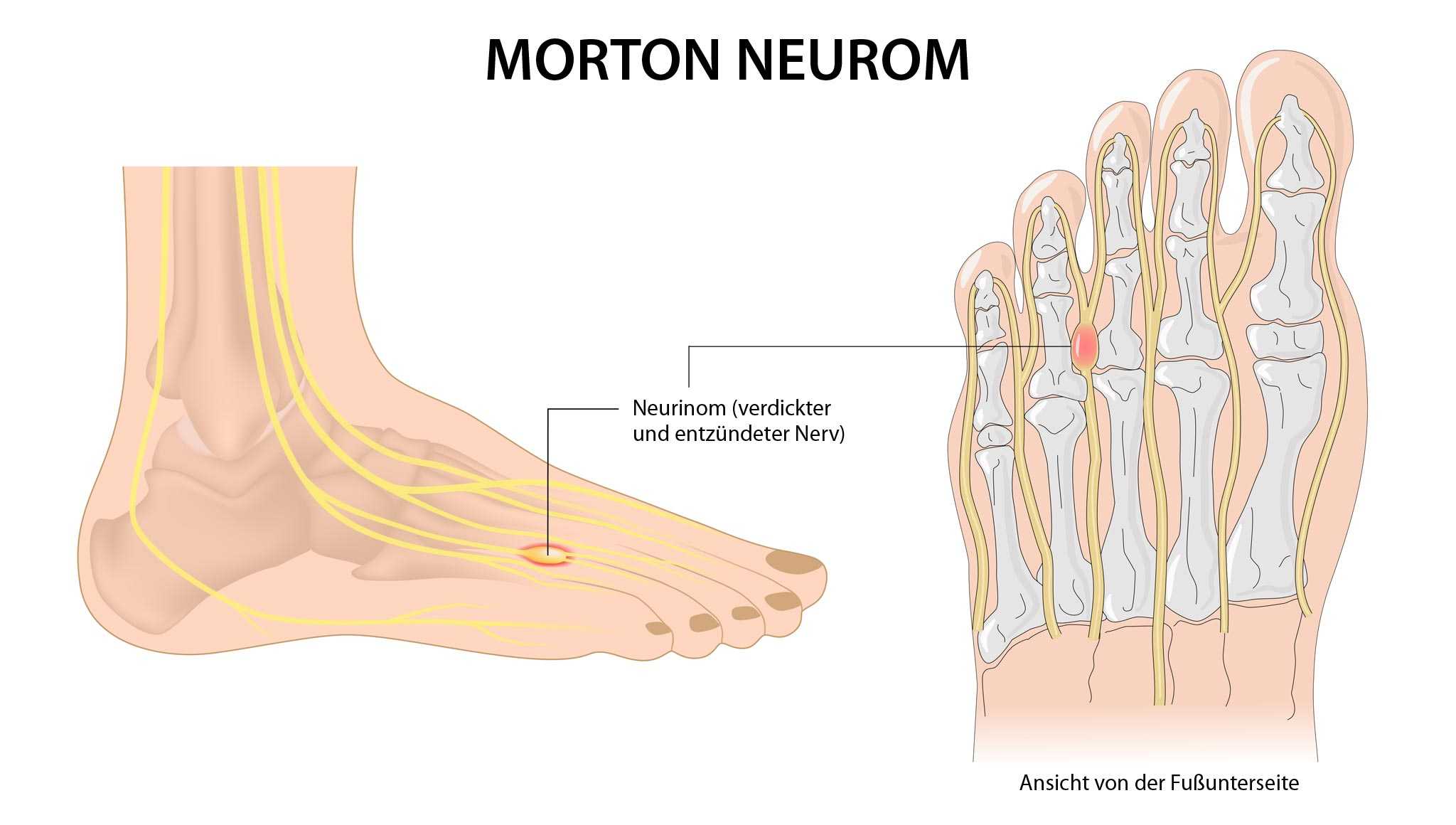 Morton-Neurom: Nervenäste zwischen den Mittelfußknochen – Anatomie und Kompression